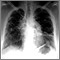 Sarcoid, stage IV - chest x-ray